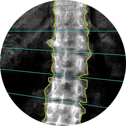 Sacramento Bone Density Scan